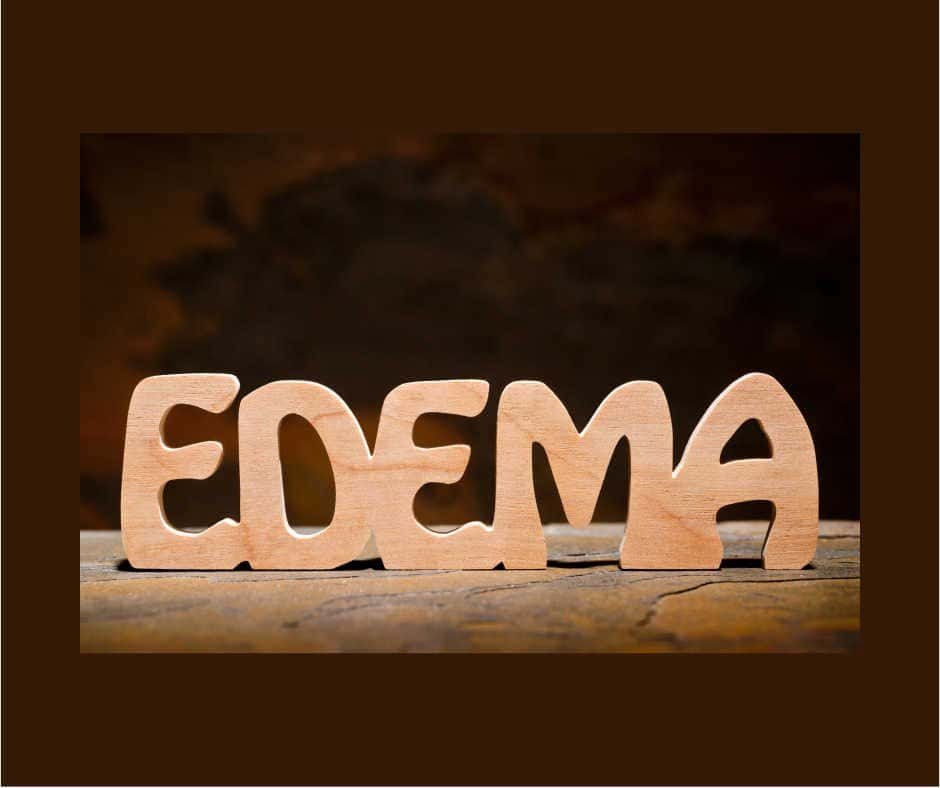 Edema